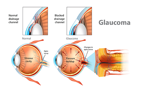 Glaucoma causes permanent vision loss when the optic nerve is damaged by pressure in the eye